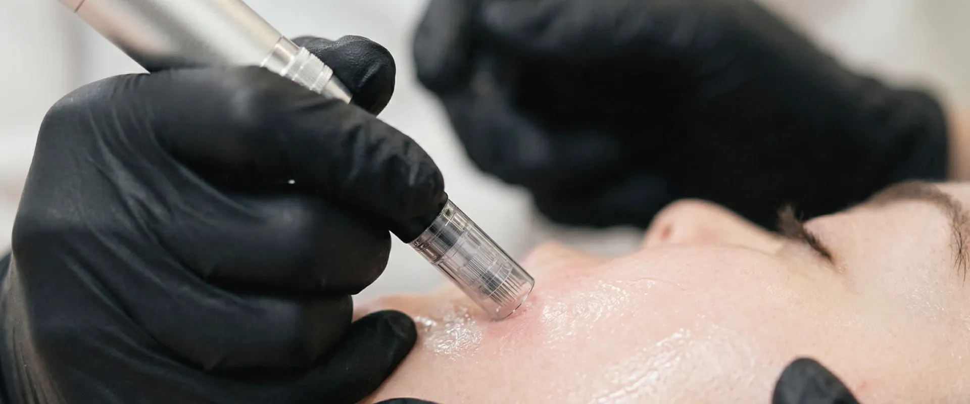 Microneedling Kurs München
