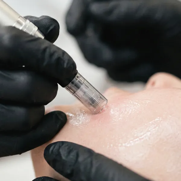 Microneedling Kurs